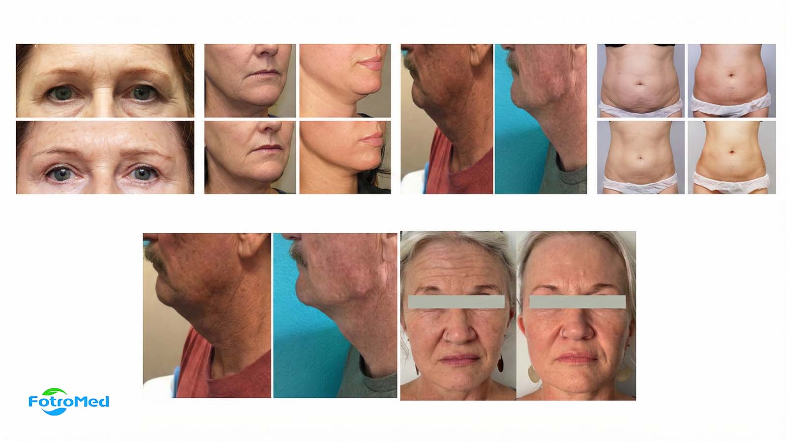 Fotrohifu Dual introduction before after 1