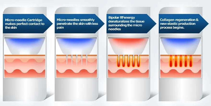 Fotromed Fractional Bi-Polar Radio frequency