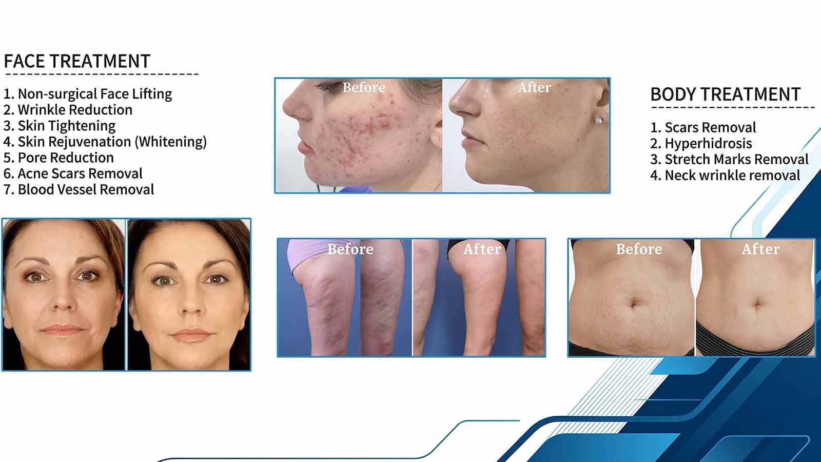 Applications of the Vacuum RF Microneedling Machine