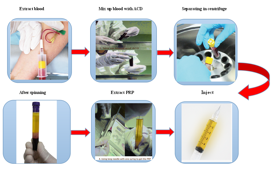 PRP procedure