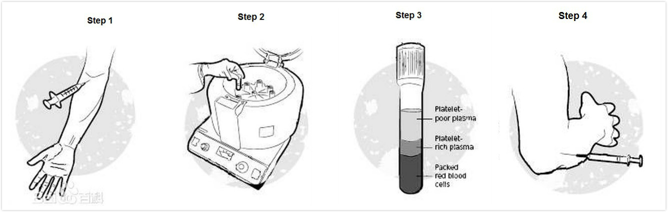 PRP procedure(1)