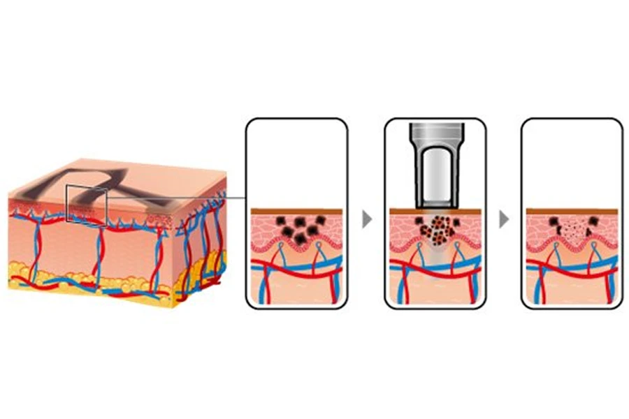 Q Switched nd yag laser 1