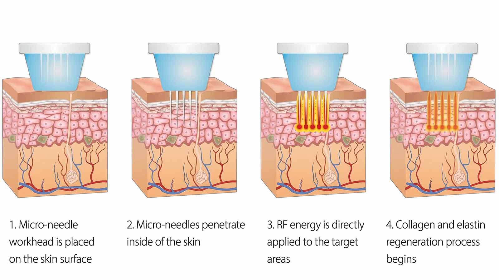 Step-by-Step Guide - Vacuum RF Microneedling Machine Process Flow