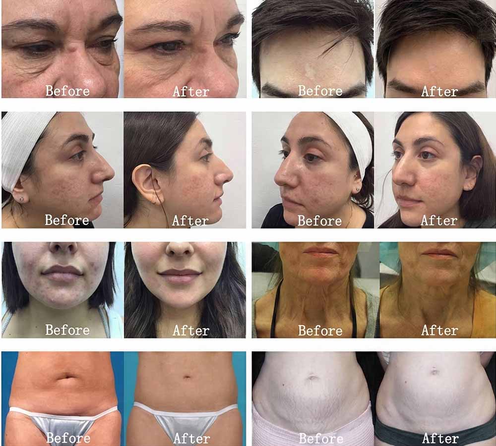 결정 깊이 8 machine before and after clinical results showing facial rejuvenation, acne scar removal, 그리고 신체 윤곽.