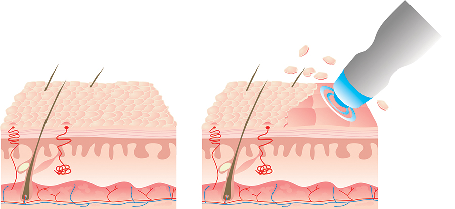 Microdermabrasion Diagram