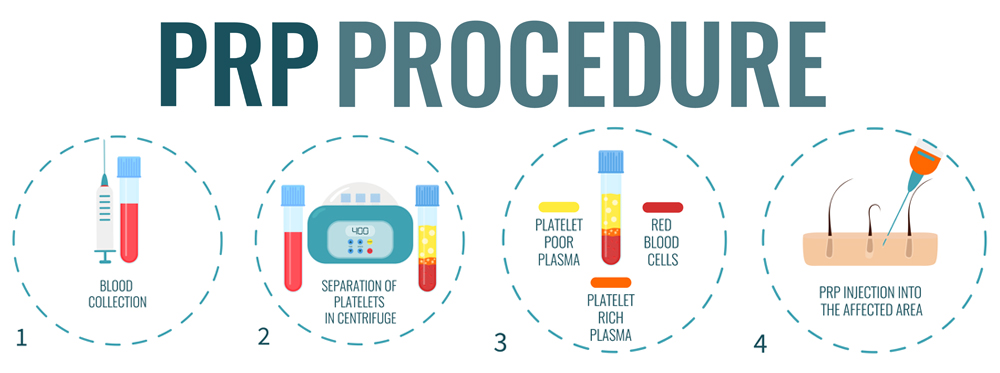 PRP procedure