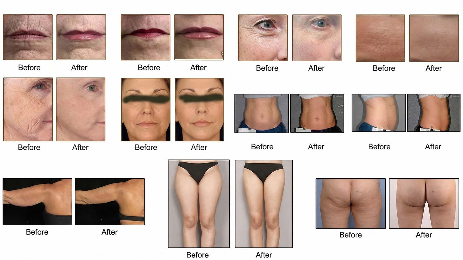 RF HIFU machine before and after clinical results, showing facial lifting and body contouring by Fotromed.