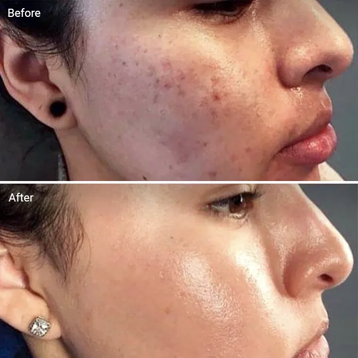 acne scarring