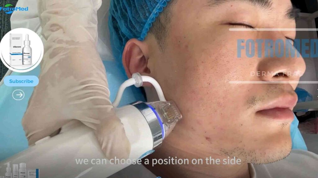 How to Use the Derma Pulse Microneedling RF Machine (4)