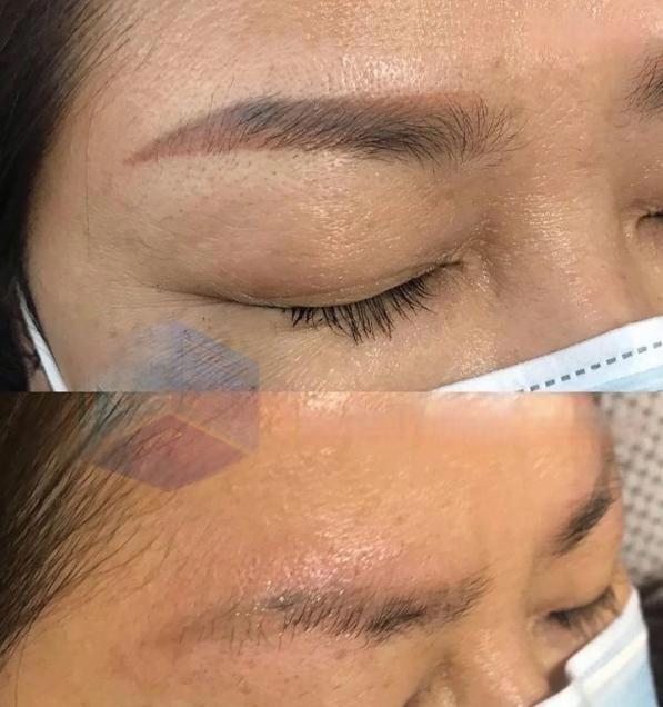 before after eyebrow removal2