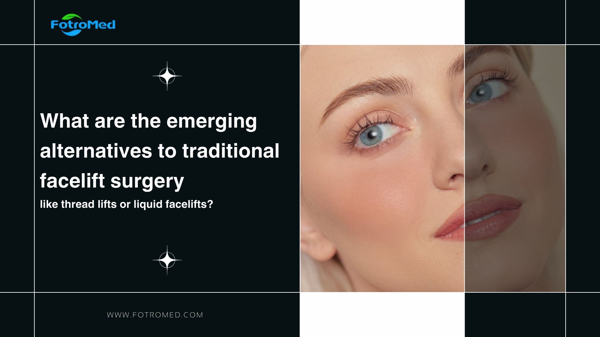 What are the emerging alternatives to traditional facelift surgery, like thread lifts or liquid facelifts