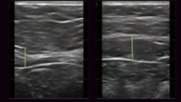 Ultrasound testing result