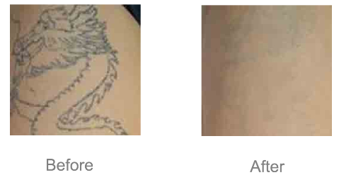 tattoo removal laser
