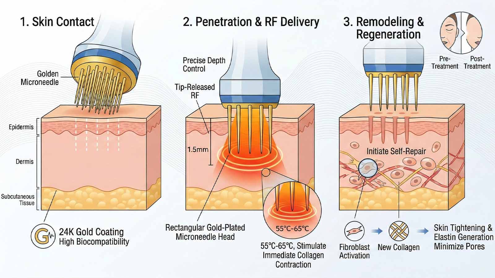 Infografis informatif yang menggambarkan proses tiga langkah microneedling RF