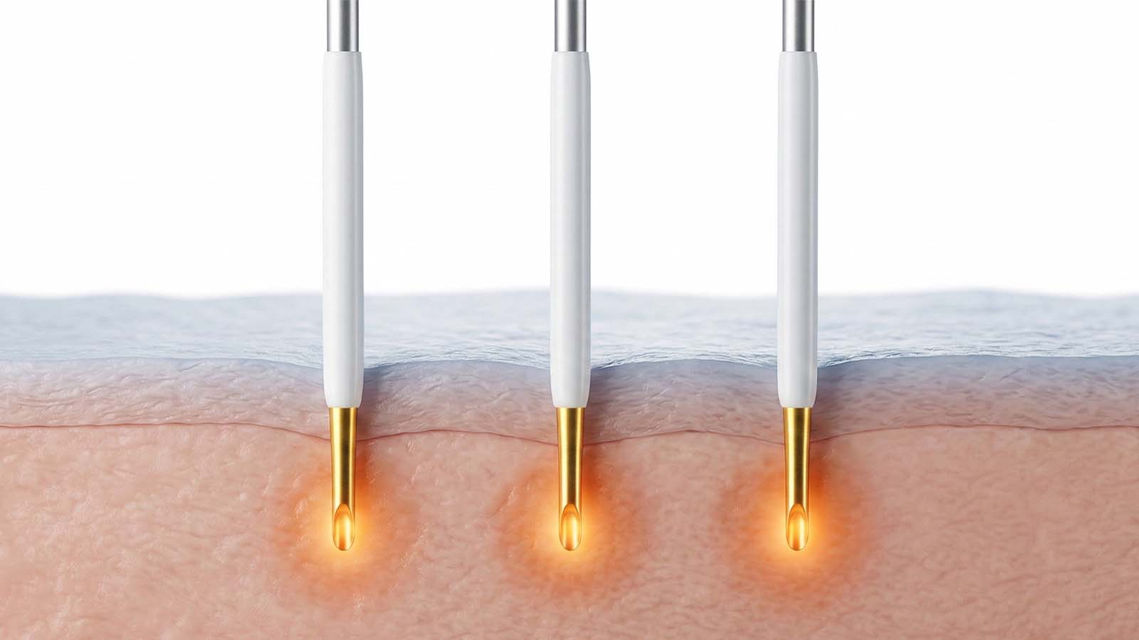 Fotromed MNRF Machine Gold Plated Insulated Needles