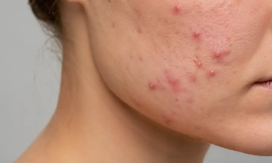Hydrodermabrasion treatment for acne and breakouts