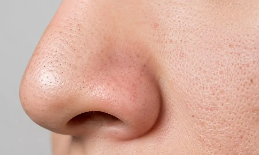 Blackhead removal and pore minimizing with hydrodermabrasion