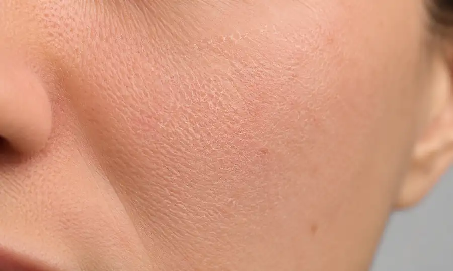 Hydrodermabrasion hydration treatment for dry skin