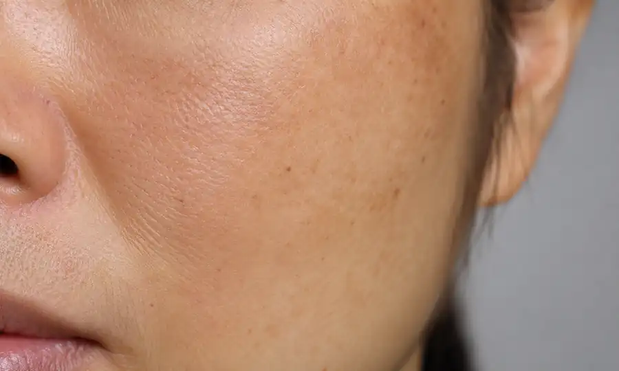 Hydrodermabrasion brightening for dull uneven skin tone