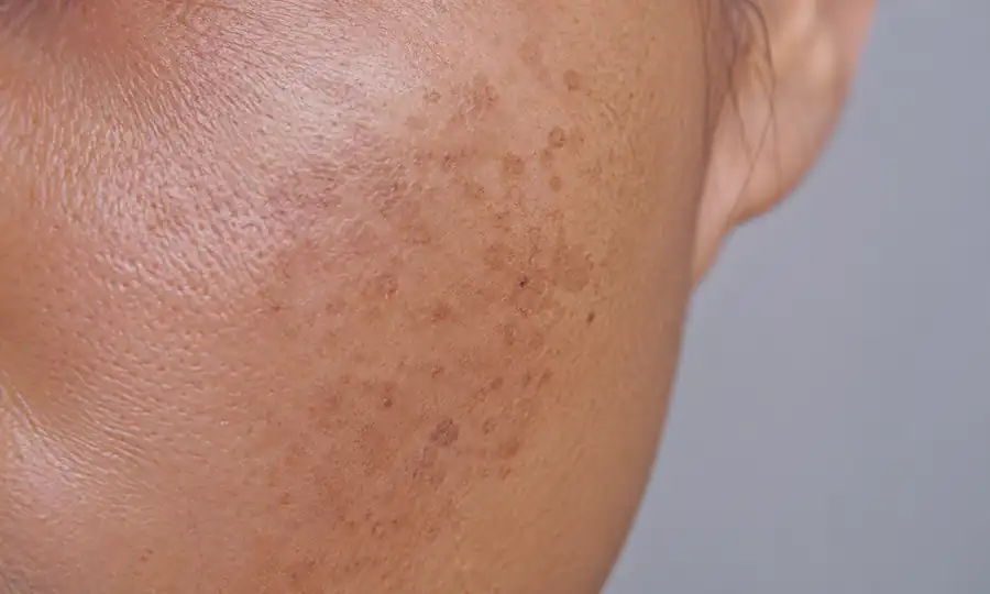 Hydrodermabrasion treatment for hyperpigmentation and dark spots