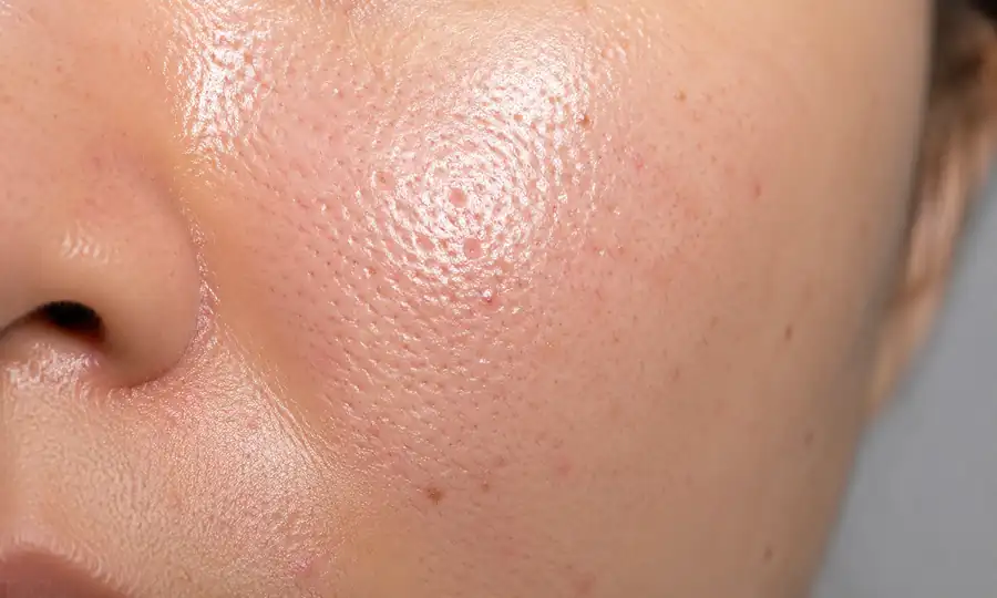Hydrodermabrasion for oily congested skin