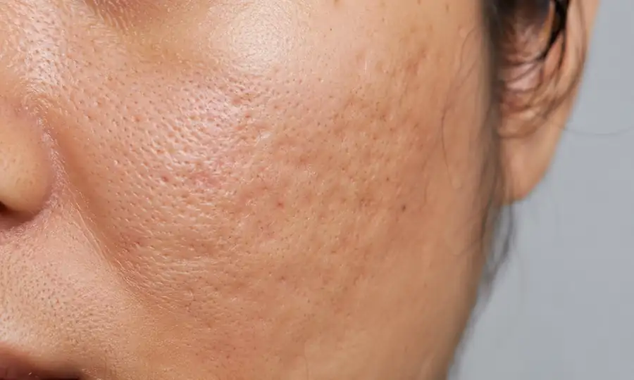 Hydrodermabrasion for rough skin texture and acne scarring