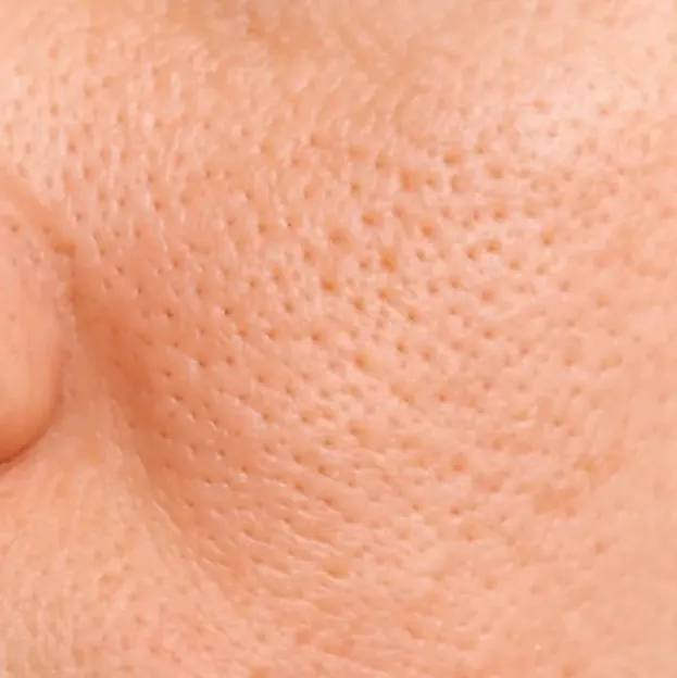 Close-up of enlarged pores and uneven cheek texture
