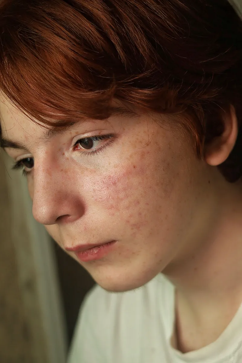 Visible facial redness on the cheek
