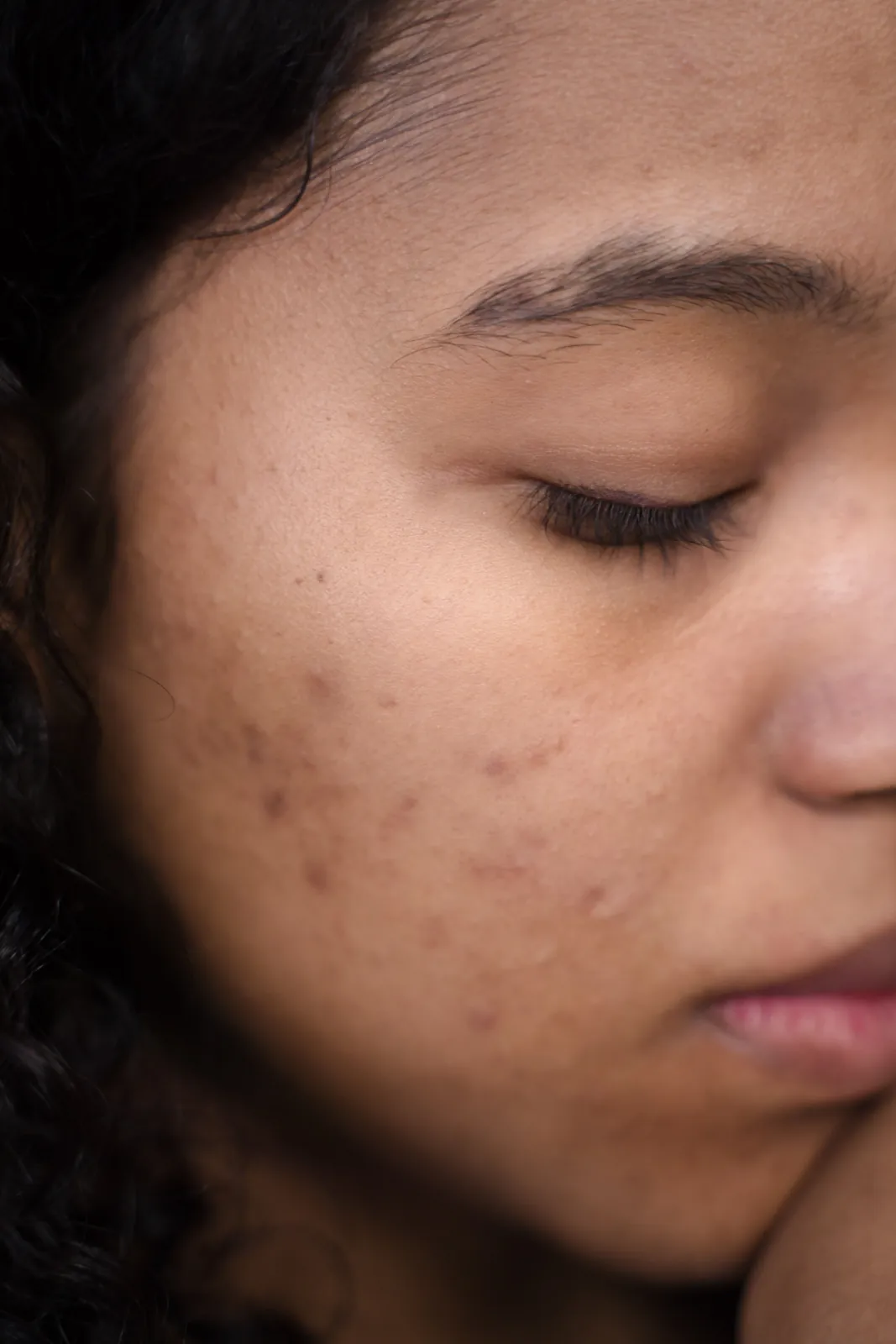 Visible dark spots and uneven tone on the cheek